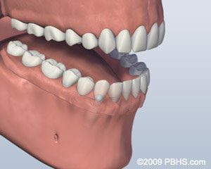 Implant Retained Dentures Yerba Buena Dentistry. Dr. Jiahua Zhu Dr. Semi Lim Dr. Varghah Lotfi Dr. Amrit K Sethi. General, Cosmetic, Restorative, Preventative Family Dentistry Dentist CA 94111