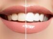 Teeth Whitening in San Francisco 94111 Yerba Buena Dentistry dentist in San Fransisco California Dr. Jiahua Zhu Dr. Semi Lim Dr. Varghah Lotfi Dr. Amrit K Sethi