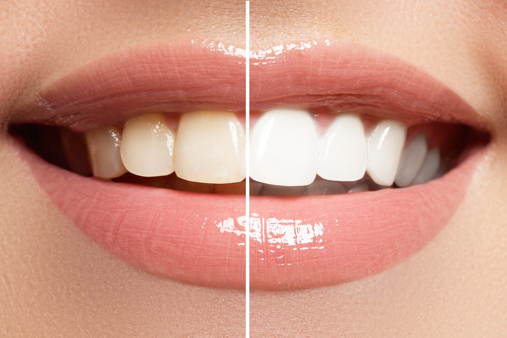 Teeth Whitening in San Francisco 94111 Yerba Buena Dentistry dentist in San Fransisco California Dr. Jiahua Zhu Dr. Semi Lim Dr. Varghah Lotfi Dr. Amrit K Sethi