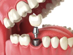 Dental Implants Yerba Buena Dentistry. Dr. Jiahua Zhu Dr. Semi Lim Dr. Varghah Lotfi Dr. Amrit K Sethi. General, Cosmetic, Restorative, Preventative Family Dentistry Dentist CA 94111