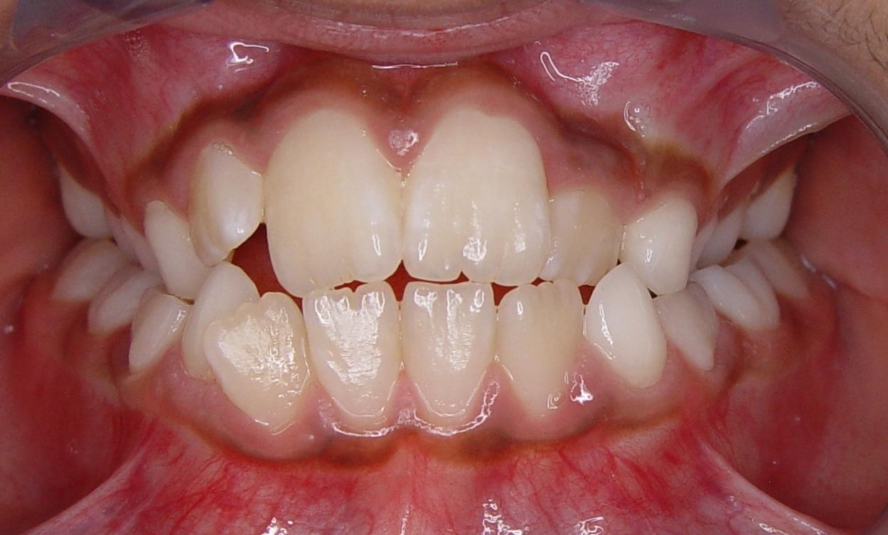 Before - 2 Traditional Braces Yerba Buena Dentistry. Dr. Jiahua Zhu Dr. Semi Lim Dr. Varghah Lotfi Dr. Amrit K Sethi. General, Cosmetic, Restorative, Preventative Family Dentistry Dentist CA 94111