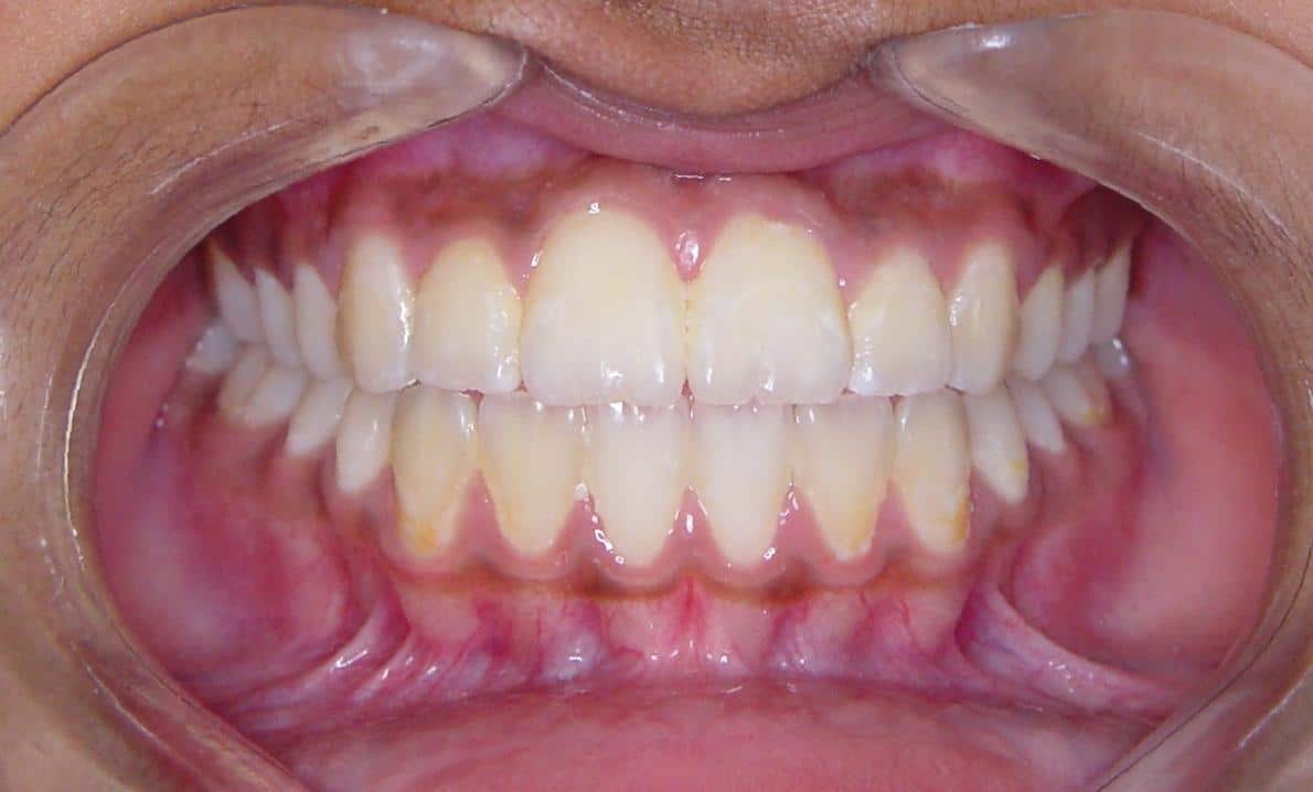 After - 2 Traditional Braces Yerba Buena Dentistry. Dr. Jiahua Zhu Dr. Semi Lim Dr. Varghah Lotfi Dr. Amrit K Sethi. General, Cosmetic, Restorative, Preventative Family Dentistry Dentist CA 94111