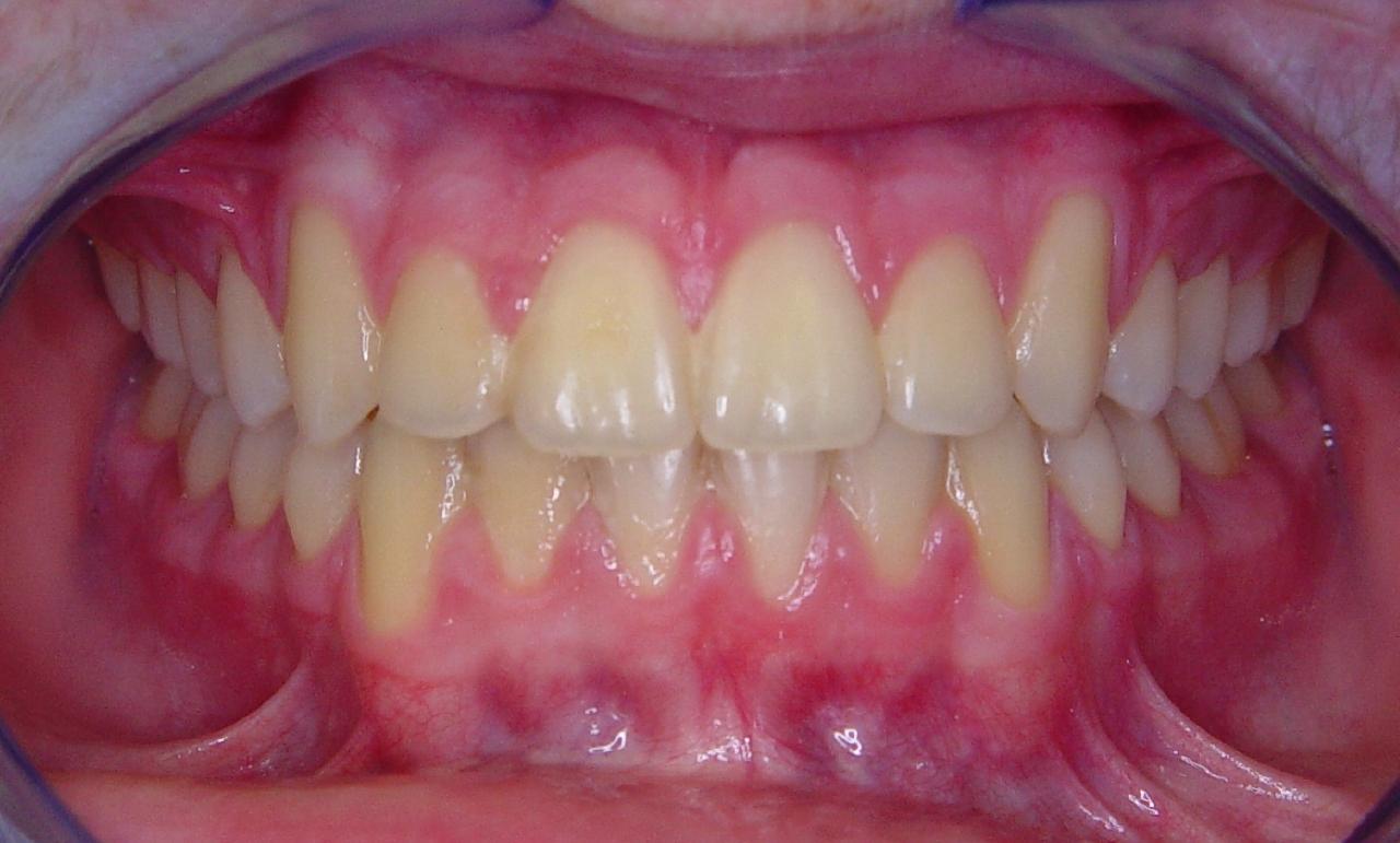 After - 3 Traditional Braces Yerba Buena Dentistry. Dr. Jiahua Zhu Dr. Semi Lim Dr. Varghah Lotfi Dr. Amrit K Sethi. General, Cosmetic, Restorative, Preventative Family Dentistry Dentist CA 94111