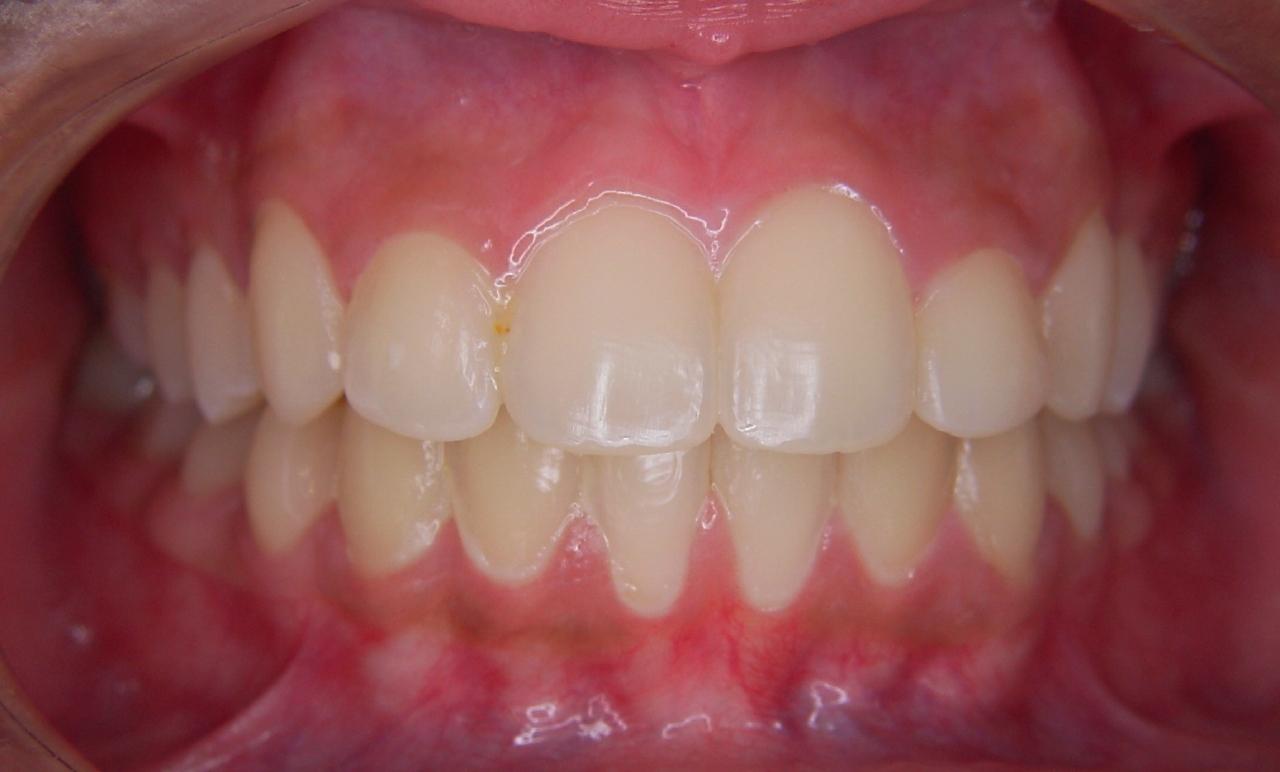 After - 5 Traditional Braces Yerba Buena Dentistry. Dr. Jiahua Zhu Dr. Semi Lim Dr. Varghah Lotfi Dr. Amrit K Sethi. General, Cosmetic, Restorative, Preventative Family Dentistry Dentist CA 94111
