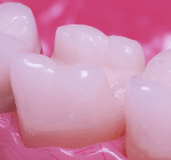 before inlay model Inlays and Onlays Yerba Buena Dentistry. Dr. Jiahua Zhu Dr. Semi Lim Dr. Varghah Lotfi Dr. Amrit K Sethi. General, Cosmetic, Restorative, Preventative Family Dentistry Dentist CA 94111