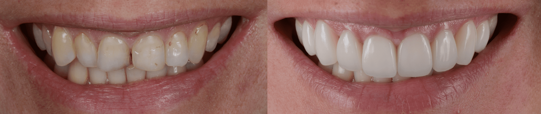 porcelain veneers before and after 1