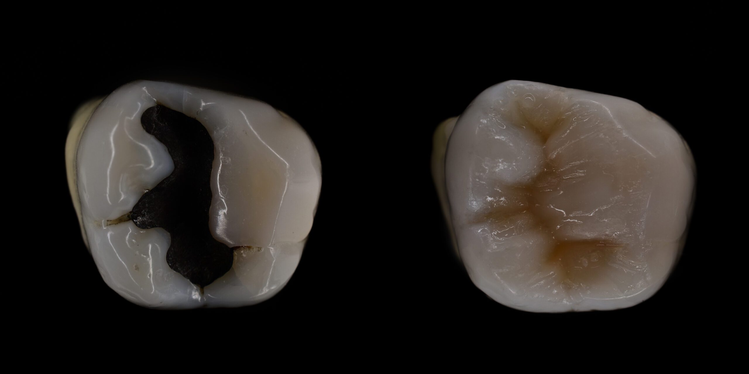 amalgam to composite before and after
