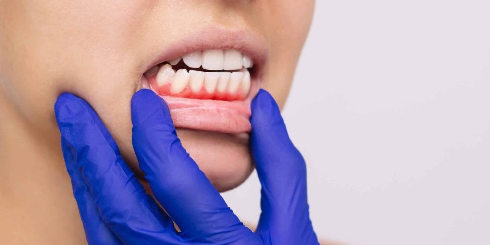 Gum Disease Treatment San Francisco