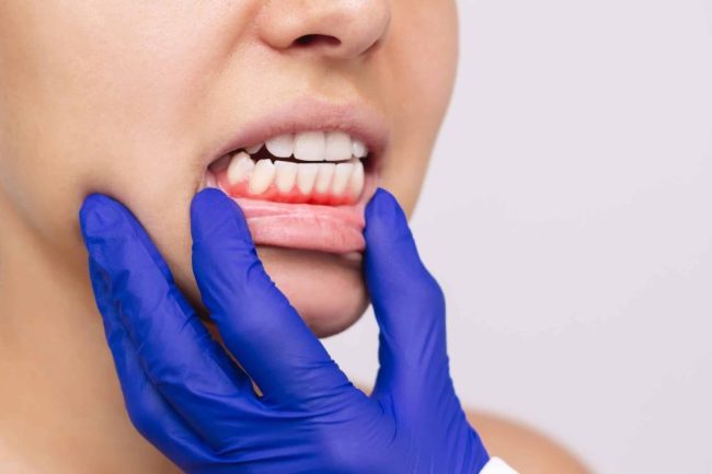 Gum,Inflammation.,Young,Woman’s,Face,With,Doctor’s,Hand,In,A Gum Disease Treatment San Francisco