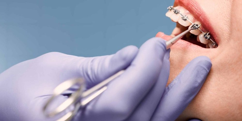 Woman,With,Wired,Metal,Braces,On,Teeth,Receiving,Orthodontic,Treatment.hands braces San Francisco