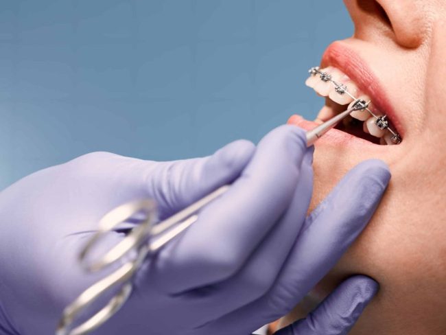 Woman,With,Wired,Metal,Braces,On,Teeth,Receiving,Orthodontic,Treatment.hands braces San Francisco