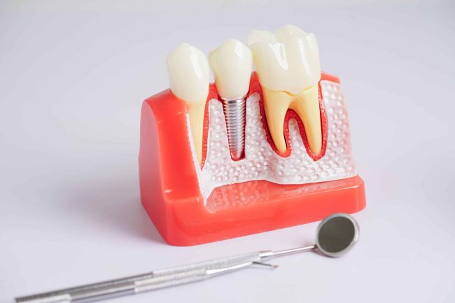 Dental,Implant,,Artificial,Tooth,Roots,Into,Jaw,,Root,Canal,Of
